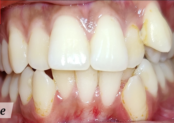 Teeth Whitening & Bleaching - Before